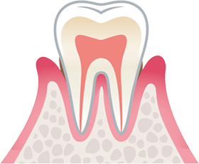 軽度歯周炎