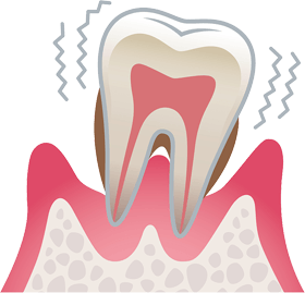 重度歯周炎